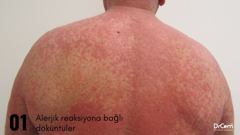 İlaç Reaksiyonu görseli - DrCem hastalık rehberi